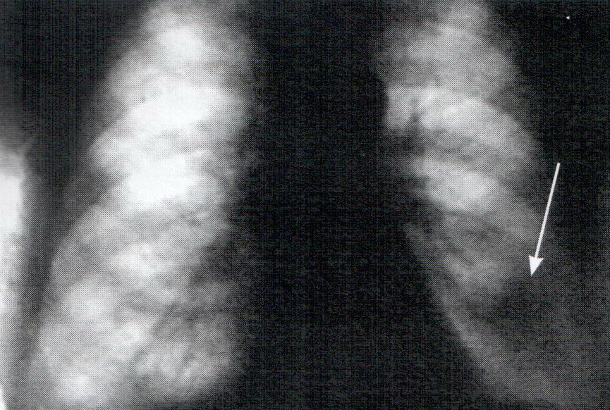 Рис 10 – Рентгенограмма легких. Периферический рак нижней доли левого легкого.