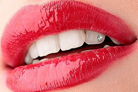 Украшение поверхности зубов ювелирными скайсами в Германии