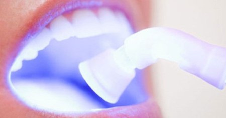 Лазерное отбеливание зубов в Германии