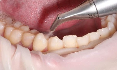 Отбеливание зубов ультразвуком в Германии
